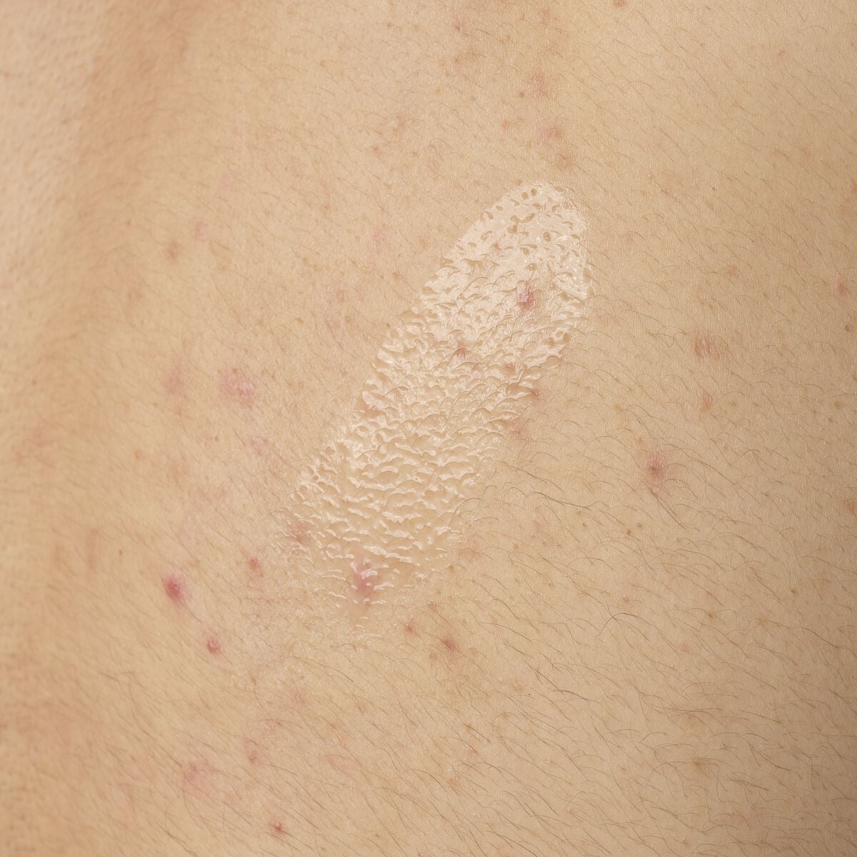salicylic-acid-0-5-body-serum-y1 ORD-salicylic-acid-05-body-240ml-application.jpg