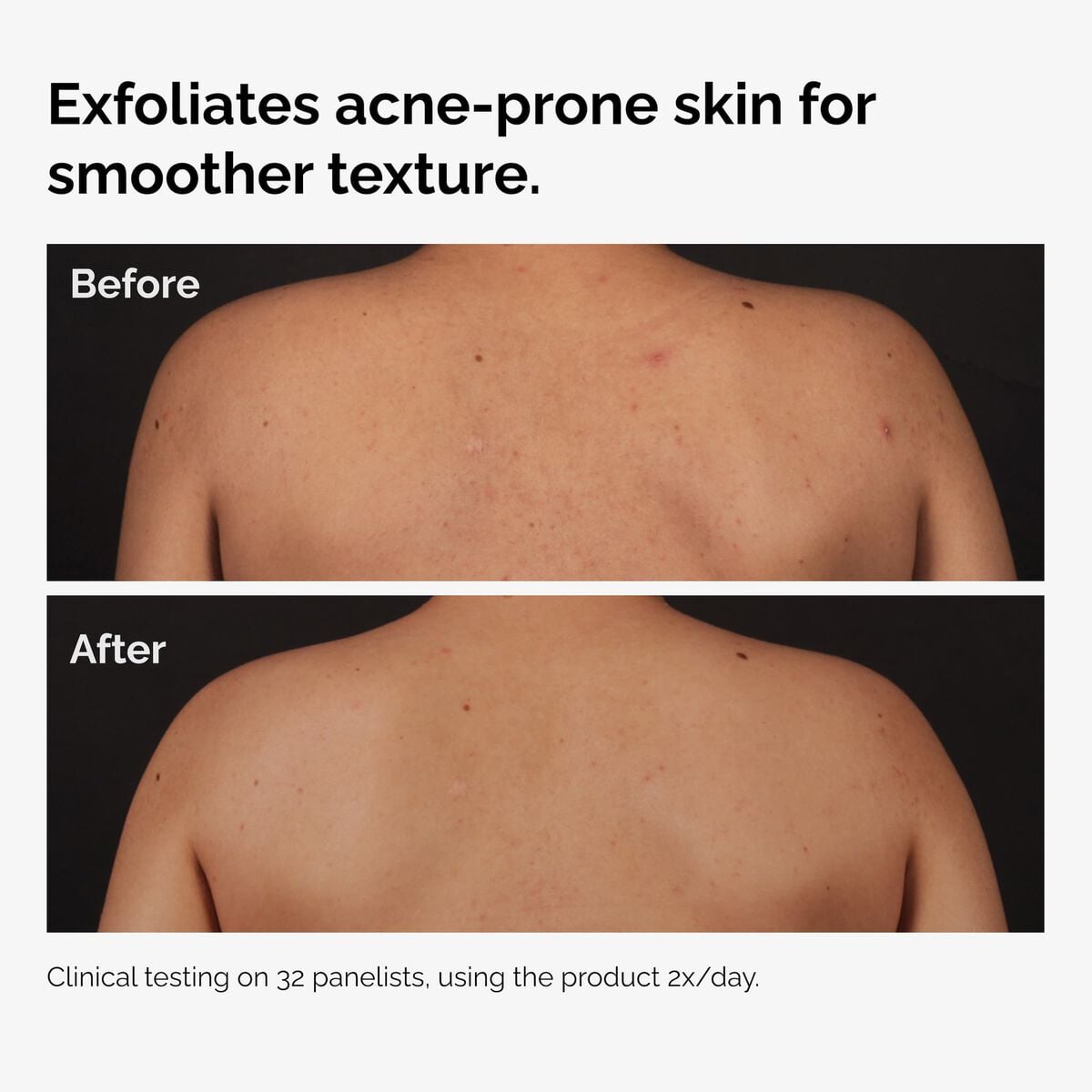 salicylic-acid-0-5-body-serum-y1 ord-salicylic-acid-body-serum-before-after-graphic-NA.jpg